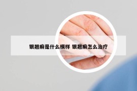 银翘癣是什么模样 银翘癣怎么治疗