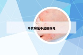 牛皮癣是不是癌症死