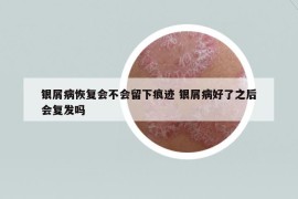 银屑病恢复会不会留下痕迹 银屑病好了之后会复发吗