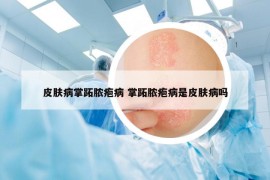 皮肤病掌跖脓疱病 掌跖脓疱病是皮肤病吗