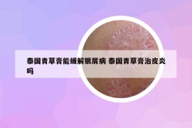 泰国青草膏能缓解银屑病 泰国青草膏治皮炎吗