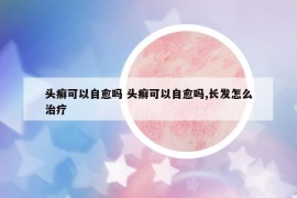 头癣可以自愈吗 头癣可以自愈吗,长发怎么治疗