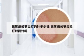 银屑病关节炎打的针多少钱 银屑病关节炎能打封闭针吗