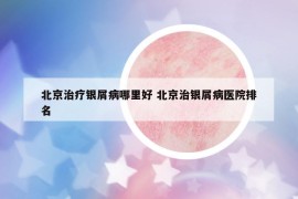 北京治疗银屑病哪里好 北京治银屑病医院排名