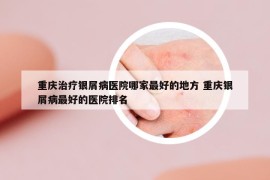 重庆治疗银屑病医院哪家最好的地方 重庆银屑病最好的医院排名