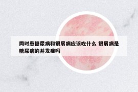 同时患糖尿病和银屑病应该吃什么 银屑病是糖尿病的并发症吗