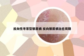 反向性寻常型银屑病 反向银屑病治愈周期