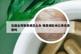 在国企得银屑病怎么办 银屑病影响公务员录取吗
