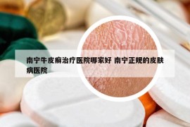 南宁牛皮癣治疗医院哪家好 南宁正规的皮肤病医院