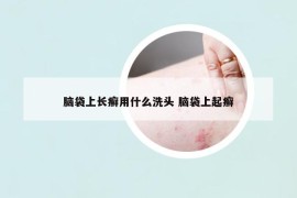 脑袋上长癣用什么洗头 脑袋上起癣