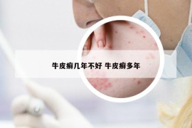牛皮癣几年不好 牛皮癣多年