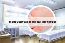 银屑病可以吃大闸蟹 银屑病可以吃大闸蟹吗
