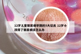 12岁儿童银屑病早期的5大征兆 12岁小孩得了银屑病该怎么办
