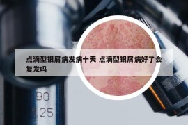 点滴型银屑病发病十天 点滴型银屑病好了会复发吗