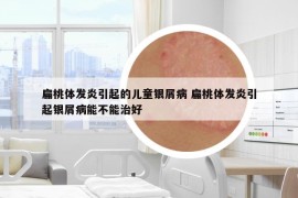 扁桃体发炎引起的儿童银屑病 扁桃体发炎引起银屑病能不能治好