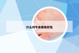 什么对牛皮癣有好处