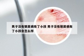 男子没有银屑病有了小孩 男子没有银屑病有了小孩会怎么样