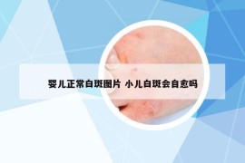 婴儿正常白斑图片 小儿白斑会自愈吗