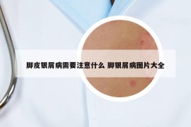 脚皮银屑病需要注意什么 脚银屑病图片大全