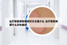 治疗银屑病有哪些好方法是什么 治疗银屑病用什么药效果好