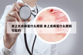 身上长皮癣是什么原因 身上皮癣是什么原因引起的