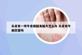 头皮有一块牛皮癣越来越大怎么办 头皮有牛癣厉害吗