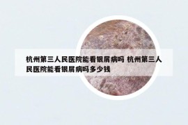杭州第三人民医院能看银屑病吗 杭州第三人民医院能看银屑病吗多少钱