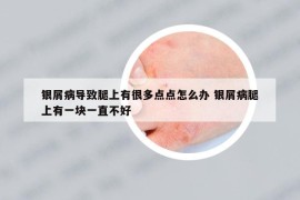 银屑病导致腿上有很多点点怎么办 银屑病腿上有一块一直不好