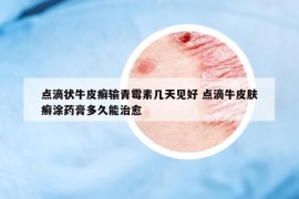 点滴状牛皮癣输青霉素几天见好 点滴牛皮肤癣涂药膏多久能治愈