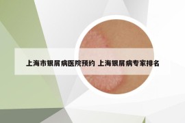 上海市银屑病医院预约 上海银屑病专家排名