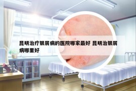 昆明治疗银屑病的医院哪家最好 昆明治银屑病哪里好