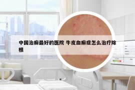 中国治癣最好的医院 牛皮血癣症怎么治疗除根