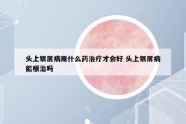 头上银屑病用什么药治疗才会好 头上银屑病能根治吗