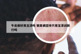 牛皮癣好用玉泽吗 银屑病坚持只用玉泽润肤行吗