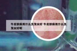 牛皮肤癣用什么洗发水好 牛皮肤癣用什么洗发水好呢