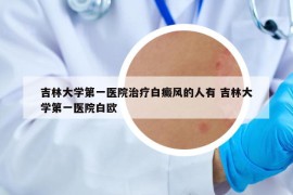 吉林大学第一医院治疗白癜风的人有 吉林大学第一医院白欧