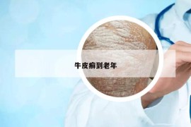 牛皮癣到老年
