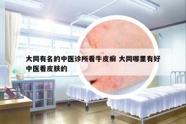 大同有名的中医诊所看牛皮癣 大同哪里有好中医看皮肤的