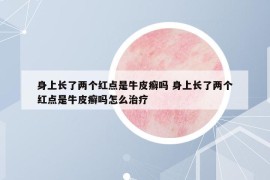 身上长了两个红点是牛皮癣吗 身上长了两个红点是牛皮癣吗怎么治疗