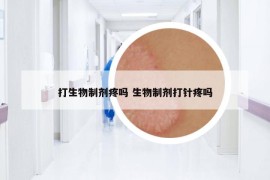 打生物制剂疼吗 生物制剂打针疼吗