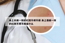 身上长癣一样的红斑不疼不痒 身上像癣一样的红斑不疼不痒是什么