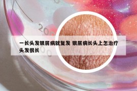 一长头发银屑病就复发 银屑病长头上怎治疗头发很长