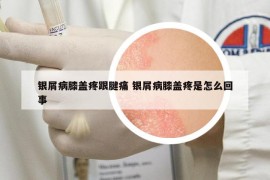 银屑病膝盖疼跟腱痛 银屑病膝盖疼是怎么回事