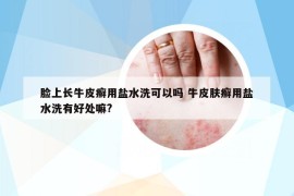 脸上长牛皮癣用盐水洗可以吗 牛皮肤癣用盐水洗有好处嘛?