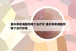 重庆银屑病医院哪个治疗好 重庆银屑病医院哪个治疗好些