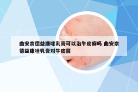 曲安奈德益康唑乳膏可以治牛皮癣吗 曲安奈德益康唑乳膏对牛皮屑
