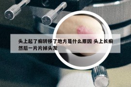 头上起了癣转移了地方是什么原因 头上长癣然后一片片掉头发