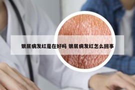 银屑病发红是在好吗 银屑病发红怎么回事