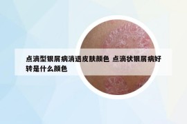 点滴型银屑病消退皮肤颜色 点滴状银屑病好转是什么颜色