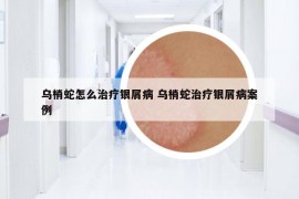 乌梢蛇怎么治疗银屑病 乌梢蛇治疗银屑病案例